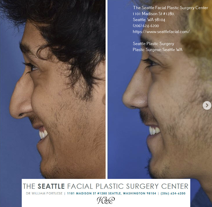 closed rhinoplasty for wide nose